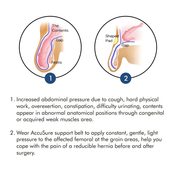 Buy AccuSure Hernia Belt for Men with 2 Removable Compression Pads Online  At Best Price @ Tata CLiQ